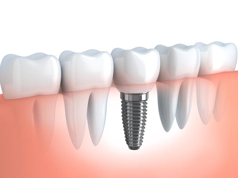 Dental Implants  Memphis, TN 