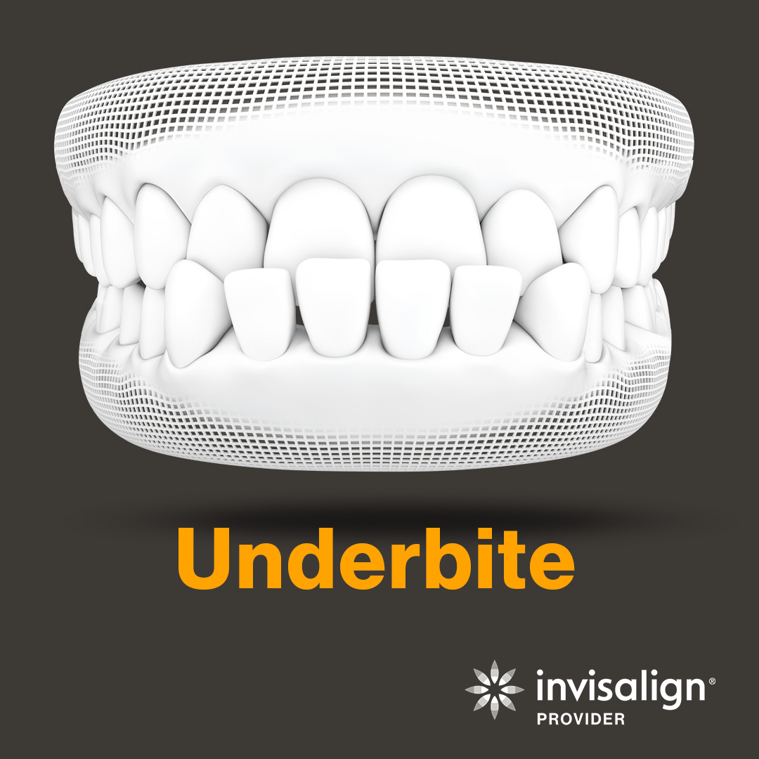 Invisalign in Memphis TN Using the most advanced Clear Aligner Systems